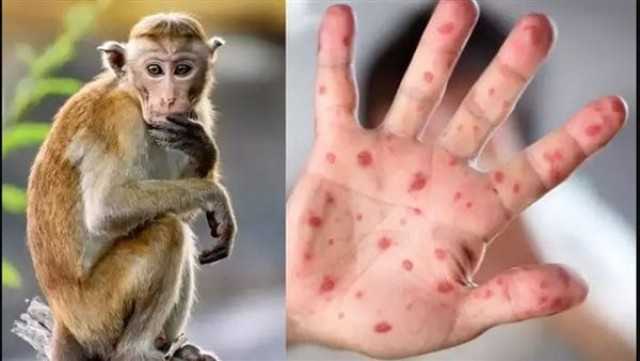 الصحة: المصاب بجدري القرود مصري من الغربية.. ولم يكن قادما من الخارج